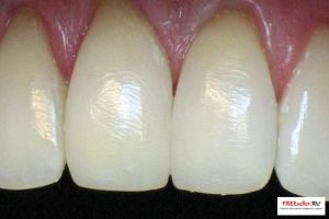 Наращивание зубов без пломбирования